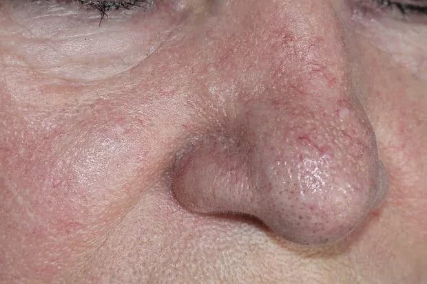 Jak wygląda zapchana cera? Objawy i skuteczne sposoby leczenia