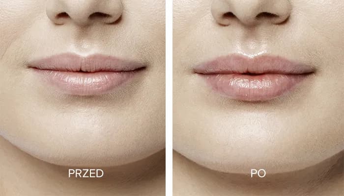 Ile kosztuje 1 ml kwasu hialuronowego w usta? Sprawdź ceny w klinikach